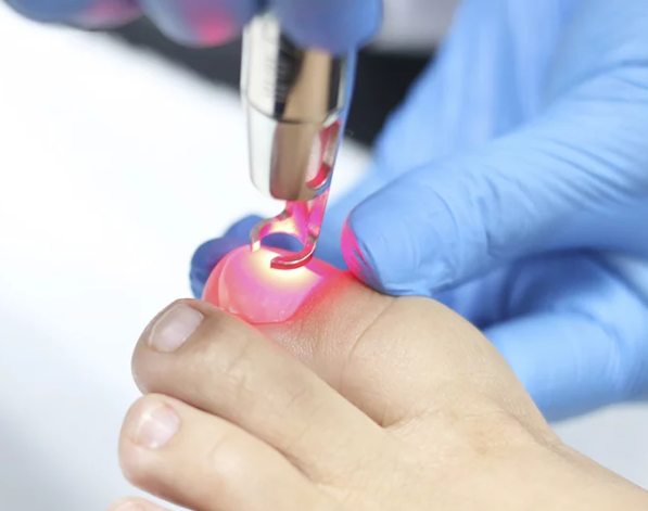 laser uñas onicomicosis